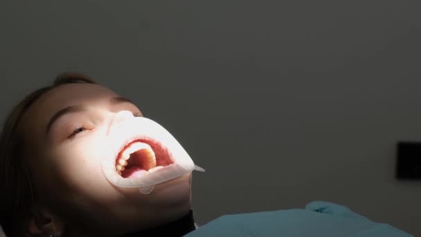 牙科治疗期间张嘴的女性患者 卡帕在治疗期间 口腔疾病的治疗过程 使用现代方法治疗牙齿 — 图库视频影像