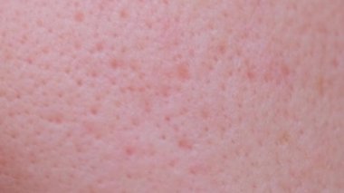 Extremely close-up technology of problem skin of a person with large own pores, acne scars. Macro photo of big pore on oily facial skin type.