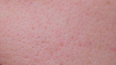 Extremely close-up technology of problem skin of a person with large own pores, acne scars. Macro photo of large pores on oily facial skin.