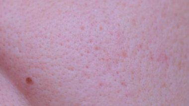 Macro video of problem facial skin of a young guy. Dermatology concept.
