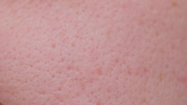 Dirty Pore Main Trouble Blackhead Acne Skin Treatment Large Pores — Stock video