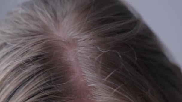 若い女の子の頭の上に灰色の髪のクローズアップ 灰色の髪の初期段階について 女性の灰色の髪の問題 — ストック動画