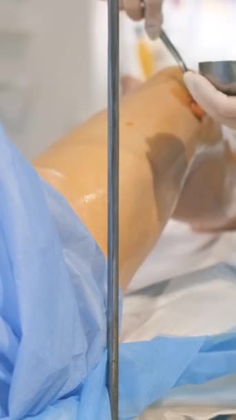 静脈外科の手術クリニックの手術室の皮膚科医は 静脈瘤のための脚の手術を行います 手術の現代的な革新的な技術 バーティカルビデオ — ストック動画