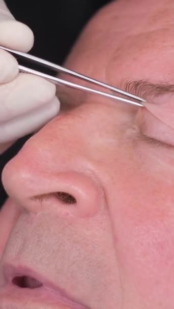 在整形手术前检查一位老人的脸 以改变眼部区域 垂直录像 — 图库视频影像