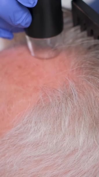 Zbliżenie Trychologa Badającego Starszego Mężczyznę Problem Łysienia Wypadania Włosów Pionowe — Wideo stockowe