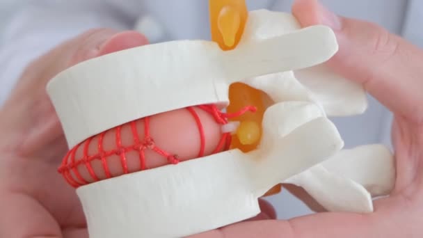 Vertebrolog Menunjukkan Model Cakram Intervertebral Mana Hernia Terlihat Nyeri Tulang — Stok Video