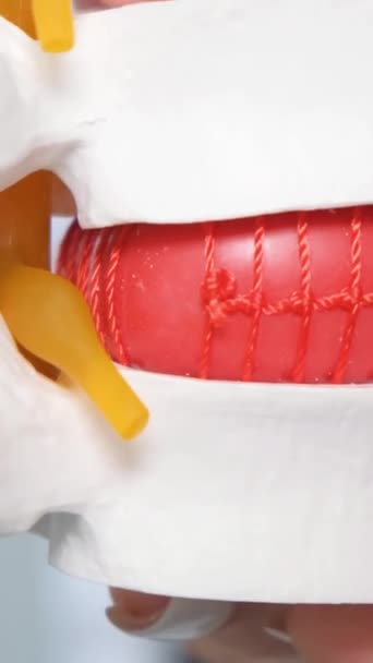 Omurgadaki Omurgalar Arası Fıtığın Yakın Plan Bir Görüntüsü Omurganın Tedavisi — Stok video