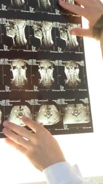 Ένας Σπονδυλολόγος Εξετάζει Μια Ακτινογραφία Μιας Γυναικείας Σπονδυλικής Στήλης Στο — Αρχείο Βίντεο