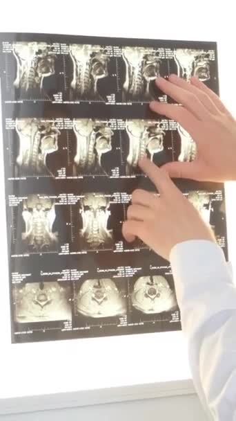 Ένας Επαγγελματίας Σπονδύλος Εξετάζει Μια Ακτινογραφία Μιας Γυναικείας Σπονδυλικής Στήλης — Αρχείο Βίντεο