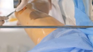 Venöz damar ameliyatının cerrahi kliniği için ameliyathanede bulunan bir phlebologist varisli damarlar için bacakları ameliyat eder. Modern, yenilikçi bir ameliyat tekniği. Dikey video