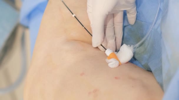 Surgeons Operate Legs Elderly Woman Varicose Veins Work Process Surgeons — Stock Video