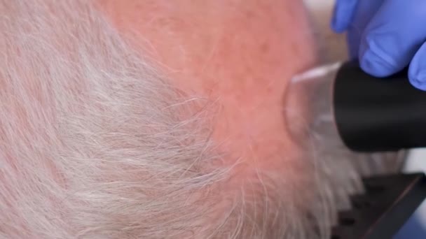 高齢者を調べる トリコロジストのクローズアップ 脱毛と脱毛の問題について バーティカルビデオ — ストック動画