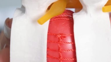 Omurgadaki omurgalar arası fıtığın yakın plan bir görüntüsü. Omurganın tedavisi. Dikey video
