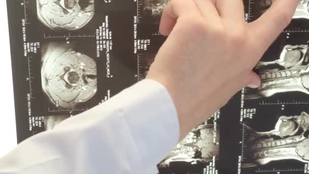 Seorang Vertebrologis Memeriksa Gambar Sinar Dari Tulang Belakang Pasien Wanita — Stok Video