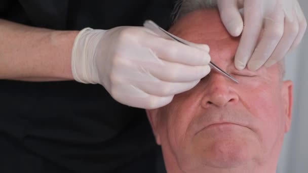 在整形外科医生检查时 男人面部的特写 整形手术的准备工作外科医生用镊子把眼部的皮肤拉紧 — 图库视频影像