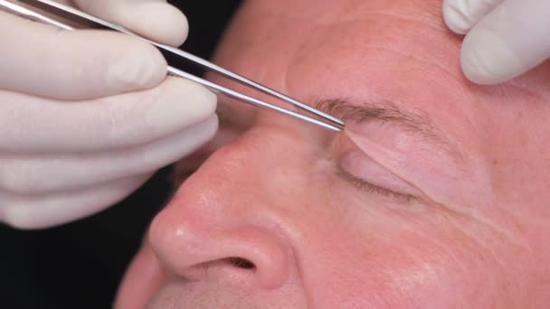 高齢者の顔にプラスチック手術の準備 プラスチック外科医は つま先が付いているまぶたの皮膚を締めます アンチエイジング医療介入 — ストック動画