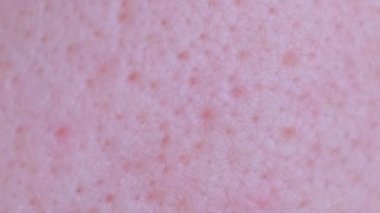 Genç bir adamın sorunlu yüz derisinin makro videosu. Dermatoloji konsepti. Dikey video.