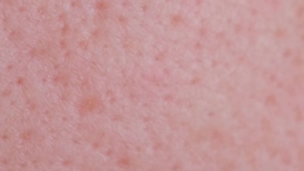 大きな穴 アクネの傷を持つ人の問題皮膚の非常にクローズアップ技術 油性顔の皮膚に大きな毛穴のマクロ写真 バーティカルビデオ — ストック動画