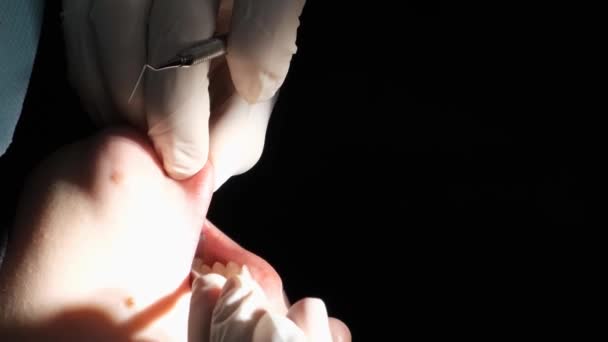 用王冠火把治疗病人牙齿的过程 牙医那里的病人牙光 垂直录像 — 图库视频影像