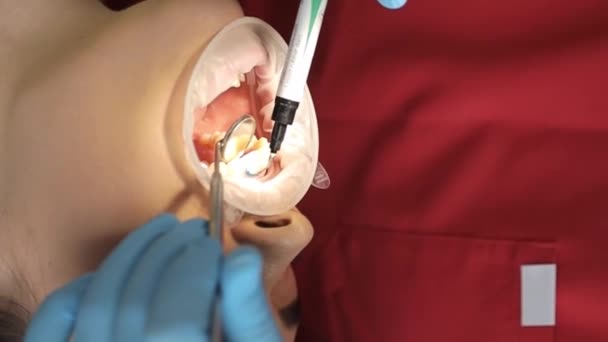 Profesjonalny Dentysta Wykonuje Zabieg Wybielania Zębów Piękny Uśmiech Nowoczesna Stomatologia — Wideo stockowe