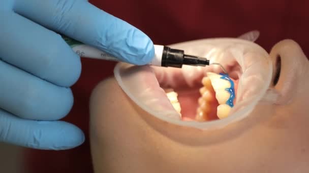 牙齿美白过程中在牙科诊所里的病人 卫生保健和医药概念 垂直录像 — 图库视频影像