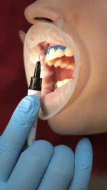 Diş beyazlatma işlemi sırasında diş kliniğinde bir hasta. Sağlık ve tıp konsepti. Dikey video