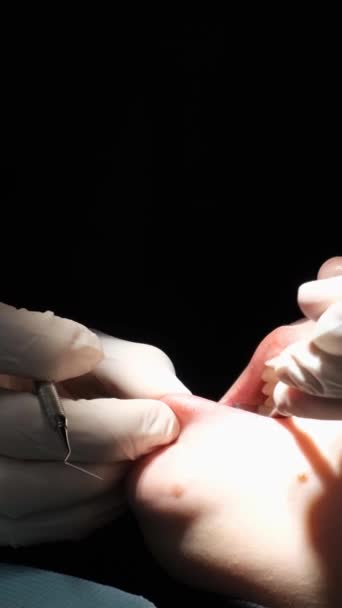 Processo Tratar Dentes Dos Pacientes Com Uma Tocha Coroa Paciente — Vídeo de Stock