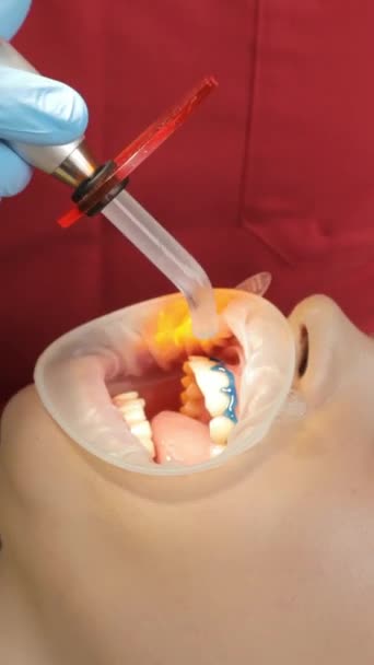 Zbliżenie Zabiegu Wybielania Zębów Ultrafioletową Lampą Ultrafioletową Pacjentka Dentysty Klinice — Wideo stockowe