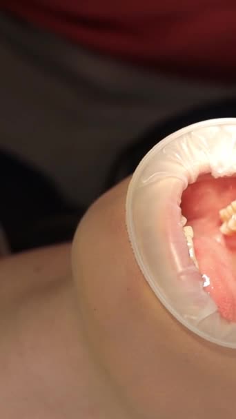 Profesionální Zubař Provádí Bělení Zubů Krásný Úsměv Moderní Stomatologie Svislé — Stock video