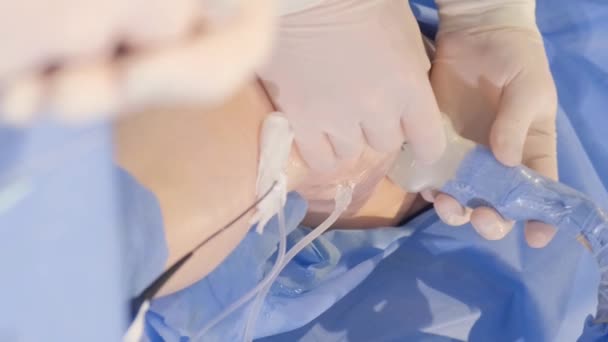 静脈のための操作 医療関係者 医師のグループによる手術のプロセス バーティカルビデオ — ストック動画