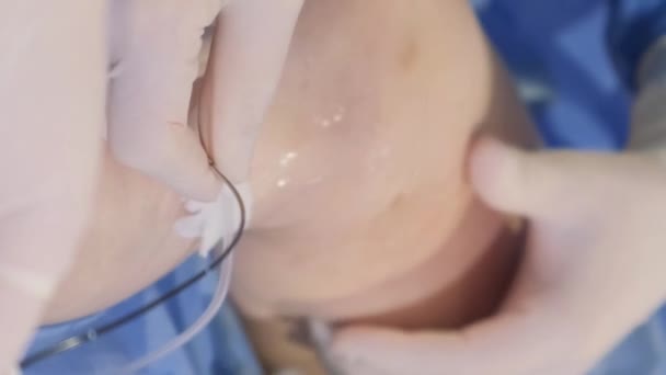Vergrößerter Plan Eines Patientenbeins Während Der Operation Bei Krampfadern Beinprobleme — Stockvideo