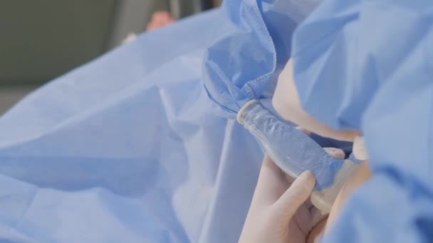 有经验的外科医生对静脉曲张进行复杂的手术 一个真正的手术在诊所 垂直录像 — 图库视频影像