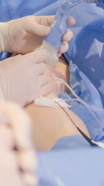 静脈のための操作 医療関係者 医師のグループによる手術のプロセス バーティカルビデオ — ストック動画
