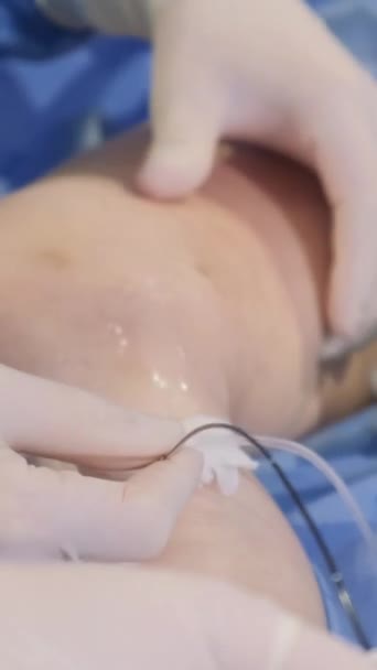 Uitgebreid Plan Van Een Patiënt Been Tijdens Operatie Voor Spataderen — Stockvideo
