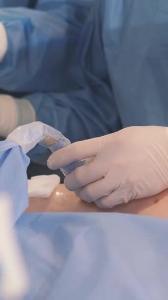 Proses Melakukan Operasi Oleh Sekelompok Dokter Profesional Seorang Dokter Bedah — Stok Video