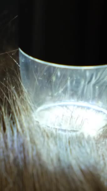 머리카락과 두피의 Trichoscopy 클로즈업 삼염색체학자는 머리카락의 상태를 진단합니다 비디오 — 비디오
