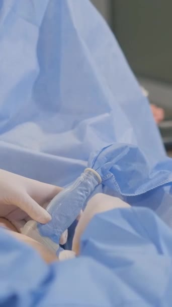有经验的外科医生对静脉曲张进行复杂的手术 一个真正的手术在诊所 垂直录像 — 图库视频影像