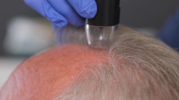 用于对头皮的毛发和皮肤进行显微检查的诊断性复合体的特写 头发问题 — 图库视频影像