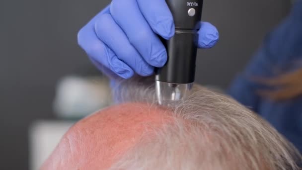 医師は頭皮の毛髪と皮膚を検査する 髪のトラブル クローズアップ — ストック動画