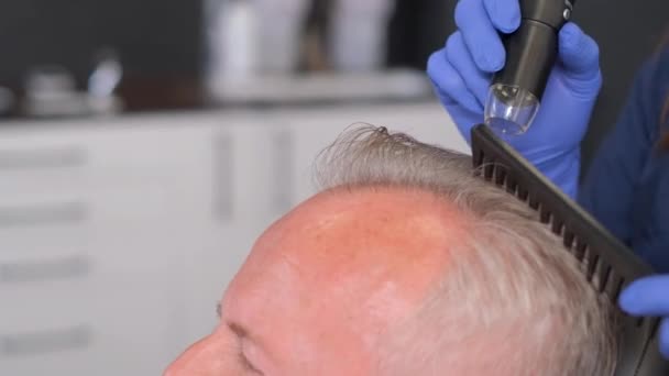 Elinde Büyüteç Olan Bir Tricholog Saç Dökülmüş Birinin Kafasını Muayene — Stok video