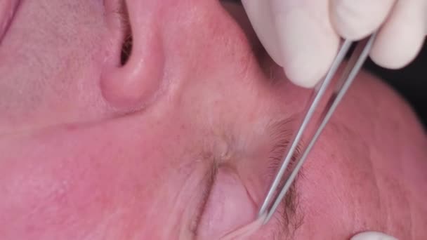Préparation Chirurgie Plastique Sur Visage Homme Âgé Chirurgien Plasticien Resserre — Video