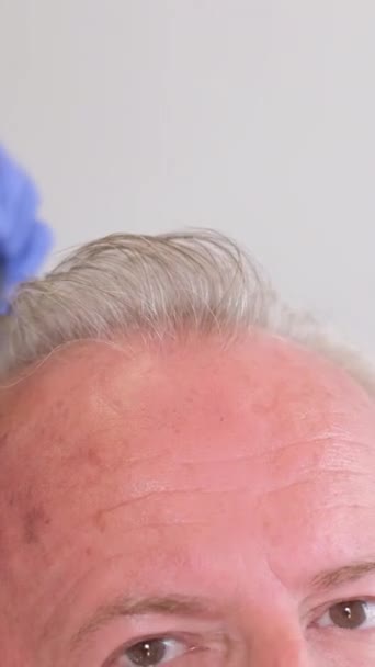 Starszy Mężczyzna Odwiedza Trychologa Problem Wypadaniem Włosów Pionowe Wideo — Wideo stockowe