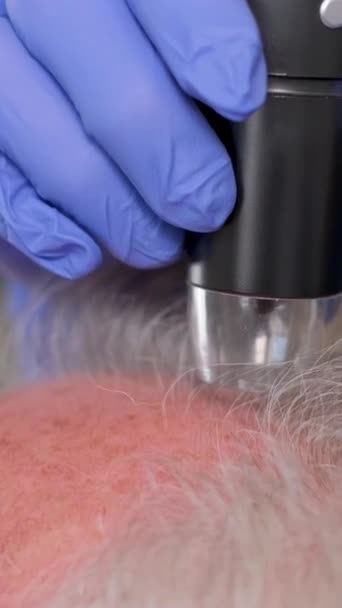 Doktor Kafa Derisinin Saç Derisini Inceliyor Saç Problemleri Kapatın Dikey — Stok video