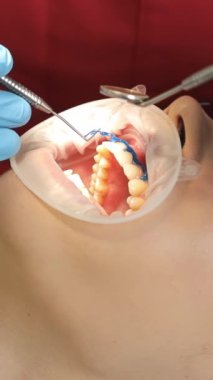 Tıbbi ekipman kullanan bir dişçinin yakın çekimi bir hastayla dişçi ofisinde çalışır. Dikey video.