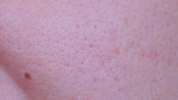 Μακρο Βίντεο Άρρωστο Δέρμα Προσώπου Πόροι Στο Δέρμα — Αρχείο Βίντεο
