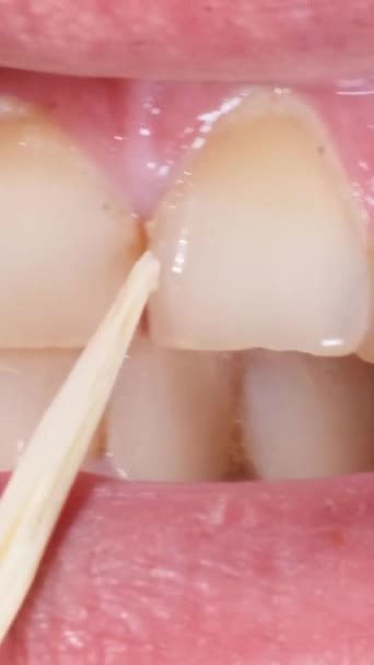 Gros Plan Homme Utilisant Cure Dent Pour Laver Les Dents — Video