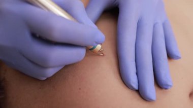 Klinikte bir erkek için lazer tüyü alınması. Güzellik Spası.