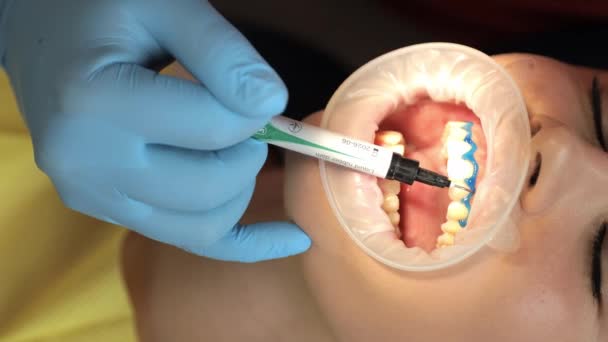 Kobieta Gabinecie Dentystycznym Przechodzi Wybielanie Zębów Jednocześnie Rzęsę Szczękę Gest — Wideo stockowe