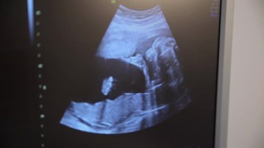 Hamile bir kadının ultrason görüntüsü monitörde mavi bir ekranda gösteriliyor. Resim, resmi olarak olayın detaylarını içeren dikdörtgen biçiminde görüntülenir