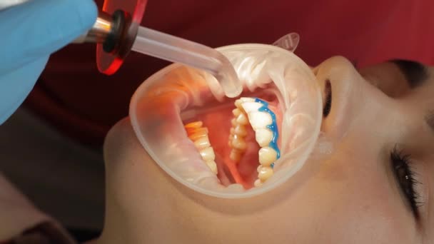 Άτομο Έχει Δόντια Τους Λευκασμένα Από Έναν Οδοντίατρο Αποτέλεσμα Ένα — Αρχείο Βίντεο